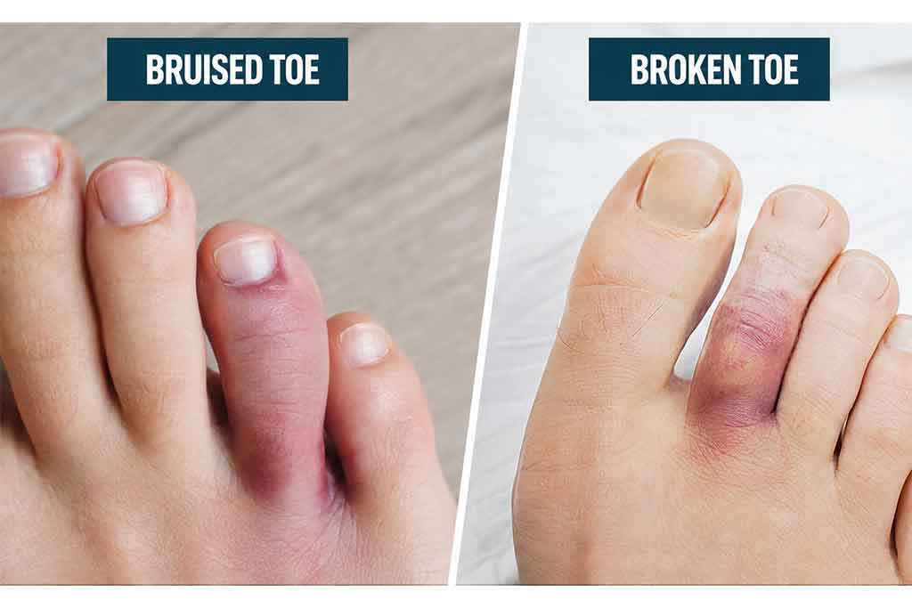 how do i know if my toe is broken or just bruised